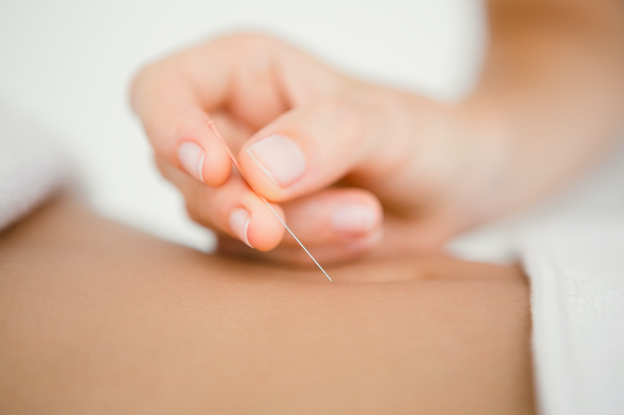 Close up view of woman holding a needle in an acupuncture therapy